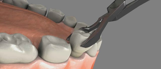 Tooth Extraction